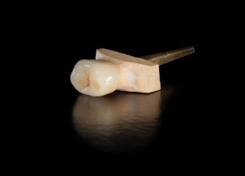 Enskild krona tillverkad av Omega Dental