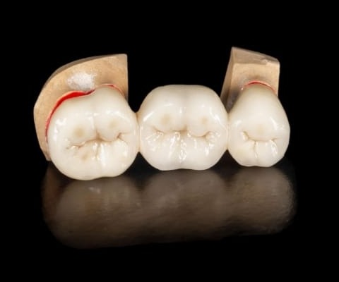 Zirkoniabro tillverkad av Omega Dental