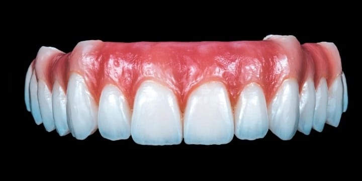 Helkäkesbro tillverkad av Omega Dental