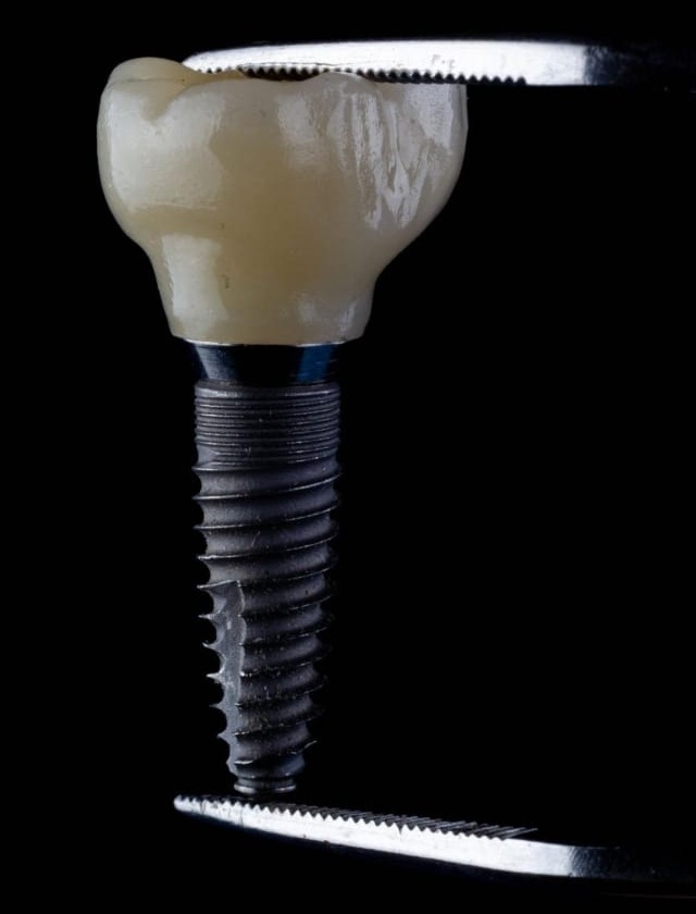 Implantatkrona tillverkad av Omega Dental